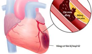 Tắc nghẽn động mạch vành do cục máu đông là nguyên nhân chính gây nhồi máu cơ tim