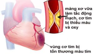 Nhồi máu cơ tim gây nguy hiểm cho tính mạng người bệnh