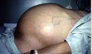 Hình ảnh bệnh nhân bị sơ gan cổ chướng